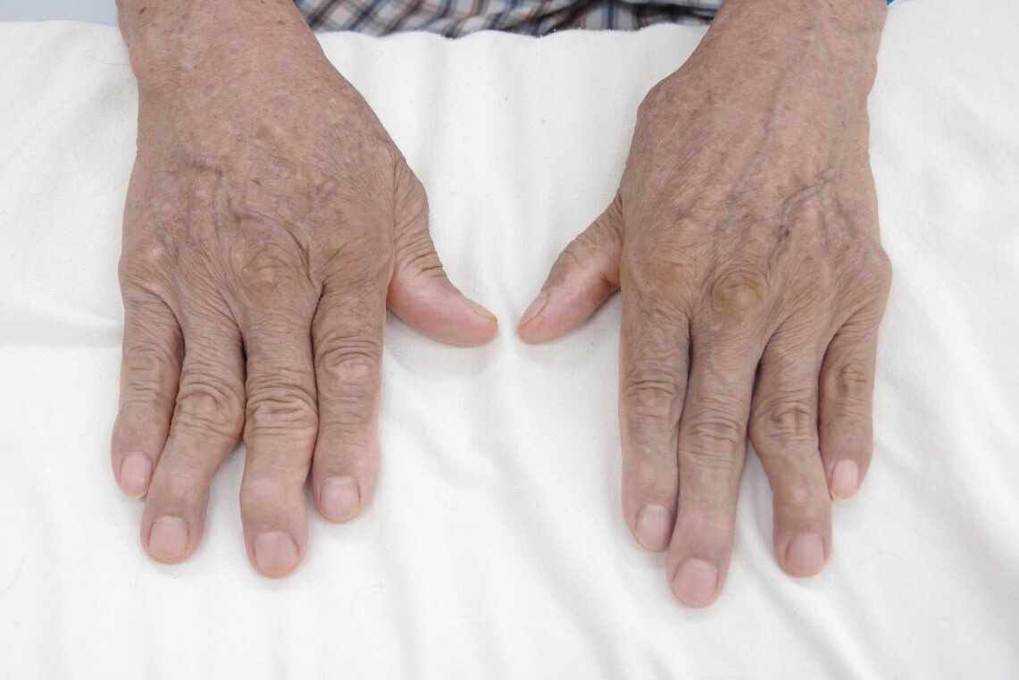 Viêm khớp dạng thấp dẫn đến đau, xơ cứng và sưng khớp. Phần lớn là khớp tay, khớp lưng, khớp bàn chân và khớp gối.